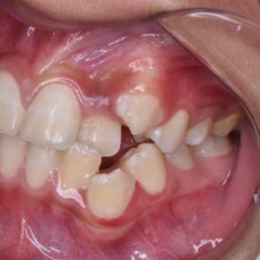 تقويم اسنان عيادة سمايل لزراعة الاسنان